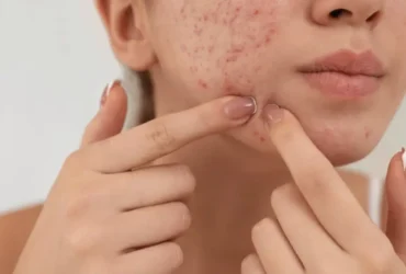 How to Treat and Prevent Acne Scars